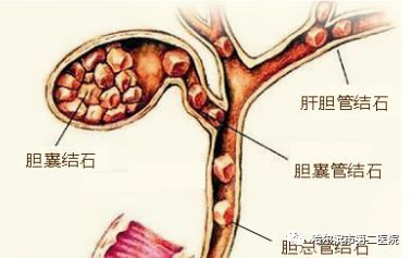 胆囊疾病的前世今生 哈市二院普外二科王胜副主任为您解读 