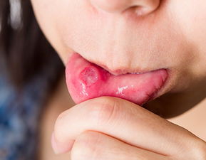 口腔溃疡引起舌头发炎