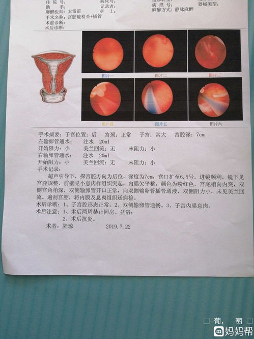 2019.7.22做的宫腔镜,有懂的吗