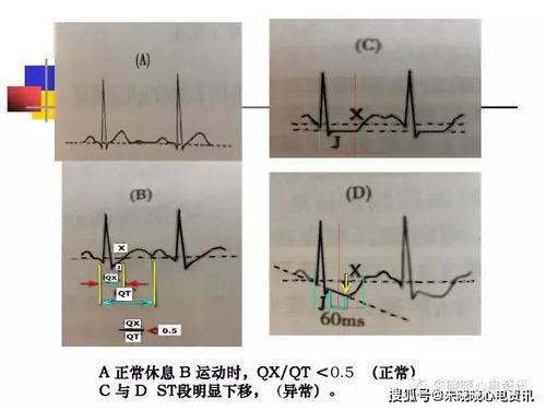 st段轻度下移是怎么回事？