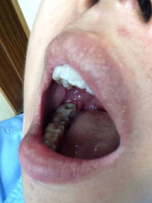 上牙龈后面长了个硬块不疼,关于上牙龈硬块不疼的情况