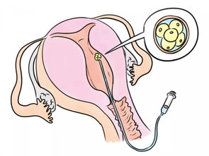试管婴儿成功率 移植注意事项和失败原因