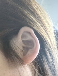 耳朵里面长痣代表什么意思