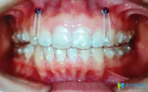 牙套的作用？牙套的作用是什么