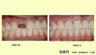 种植牙修补牙齿缺失 悦美整形 