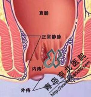 痔疮有哪些征兆 青岛京北医院 