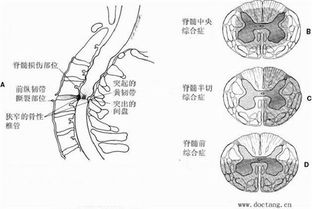 如何治疗颈部脊髓损伤后遗症 