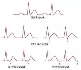 心跳过速怎样可以缓解