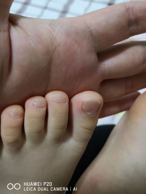 我家孩子2岁4个月,今天发现有一个脚趾甲和其他脚趾甲不一样,请教有问题吗,是传说中的灰指甲吗 