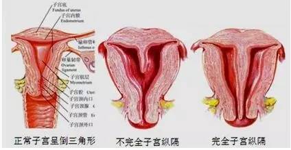 子宫纵隔一定要做手术吗 