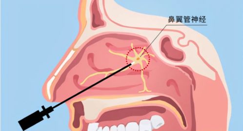 蝶窦炎发作,遭罪的不仅仅是鼻子