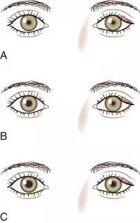 瞳孔不等大 动眼神经麻痹还是Horner综合征 