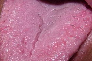 舌头烂最简单方法,舌头烂最简单方法治疗方法