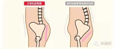 骨盆变形的原因及症状,你有吗