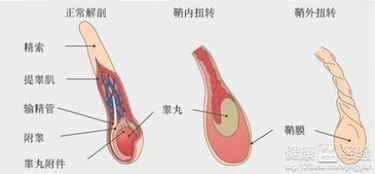 睾丸扭转的原因是什么呢