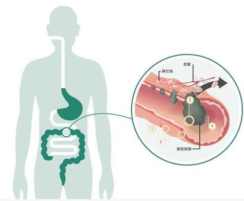 同样是肠癌,为什么症状还不一样 医生辟谣告诉您肠癌应该怎么防