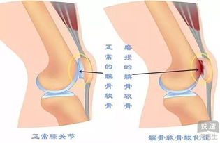 预防髌骨软化别反复下蹲