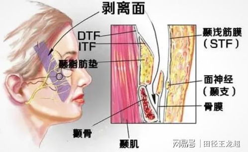 解答 筋膜悬吊效果消失了会不会更丑 做了筋膜悬吊悔不当初啊