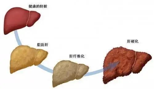 重度脂肪肝做什么运动好呢,剧烈的减脂运动适合吗