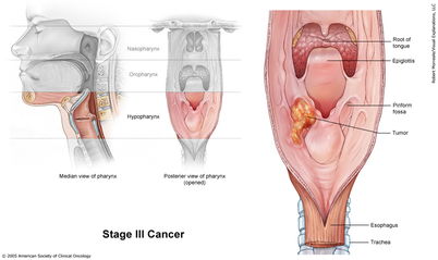 喉癌及其放射治疗 图文,科学普及版