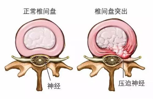 腰椎间盘突出症,您所关心的那些事儿