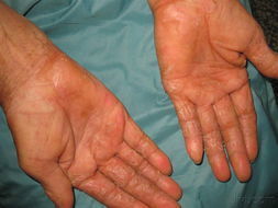 皮肤真菌感染用什么药最好,手上皮肤真菌感染用什么药最好