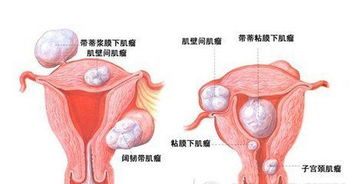 宫颈癌症状图片 