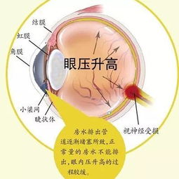 黑暗中玩手机会得青光眼吗 40岁以上最好每年给眼睛做个体检 