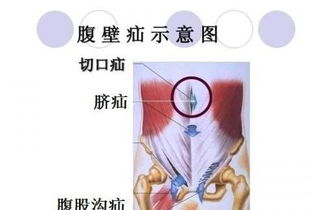 肾下垂可以摸到腹部硬块 什么是肾下垂肾下垂的发病原因是什么