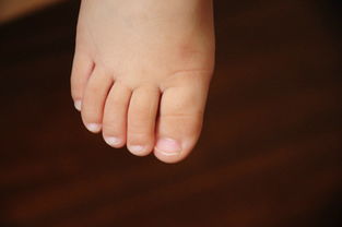 宝宝脚趾甲有白斑