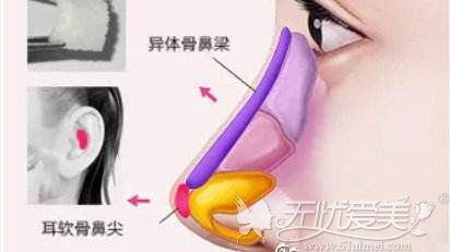 人工骨和异体骨在隆鼻上有什么区别 会留下后遗症吗