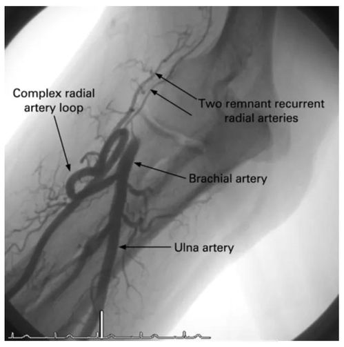 经桡动脉入路的介入治疗