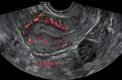 详解子宫内膜的厚度 类型及形态