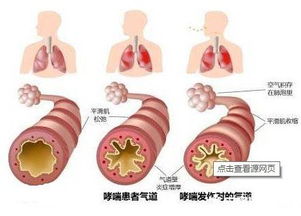支气管哮喘病的发病机制 
