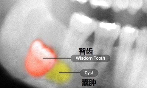 去医院拔智齿，智齿根断在里面了，医生说弄不出来，会有问题吗(智齿拔牙断根拔不出来影响大不)