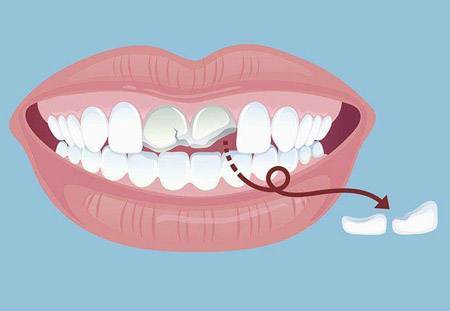 牙齿门牙断了可以补吗