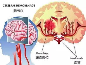 冬天易发脑出血,年轻人也别放松警惕