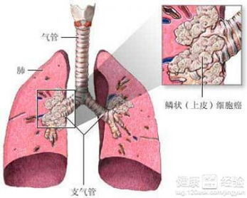 小细胞肺癌能活多久