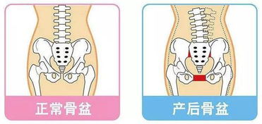 生完孩子后胯骨变宽 大屁股,盆骨修复怎么做