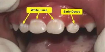 牙齿上出现白点是怎么回事