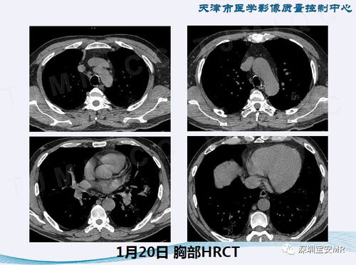 新型冠状病毒感染肺炎影像学表现 阶段性总结