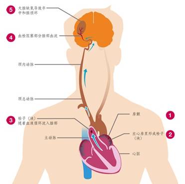 生活与健康 不可忽视的心耳危机