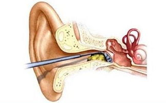 掏耳朵暗藏4大危害,千万别随便掏 正确清理方式是... 