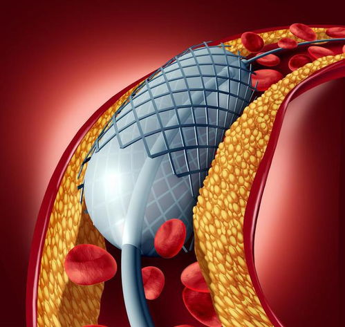 心脏支架到底对人体有没有危害 冠心病啥时该放支架