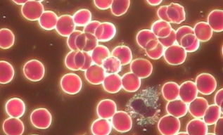 发烧中性粒细胞高白细胞正常,发烧不退,白细胞正常,中性粒细胞升高