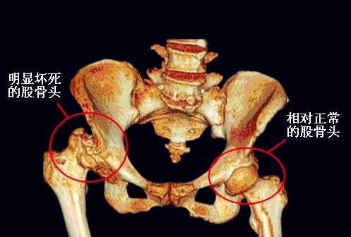 科普 股骨头坏死只能手术 治疗需先看坏死阶段,股骨头能保就保