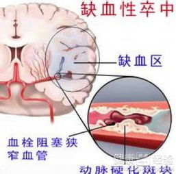 重脑梗塞病人如何饮食