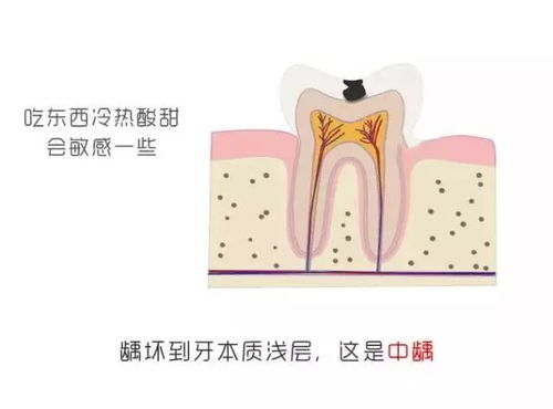 牙疼这种 小 问题,可能真的会危及生命 附送最实用看牙攻略