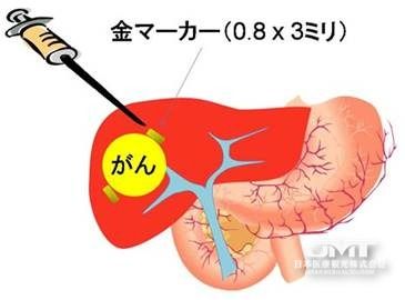 JMT 针对肝癌日本质子治疗的适应症是哪些