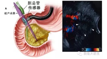 福建省立医院内镜团队 超声内镜引导下胆管会师术 